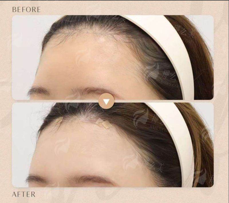 三、苏州沐兰清颜做幼态脸要多少钱？值不值？