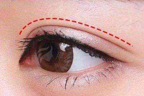 一、青岛华颜美双眼皮整形有哪些特色?