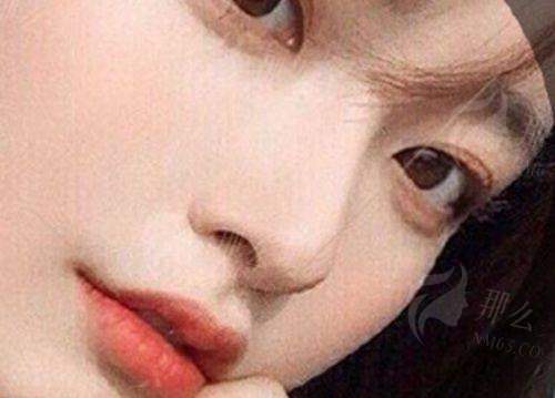 二、御美汇做隆鼻修复要多少钱?