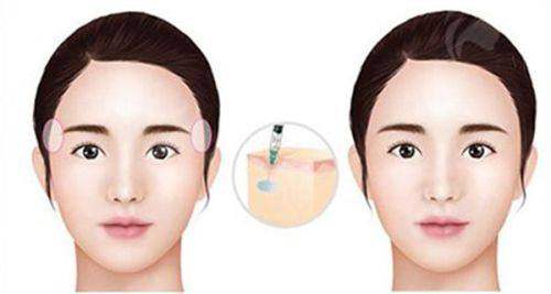 四、孙家明和杨国粱双眼皮自然度对比