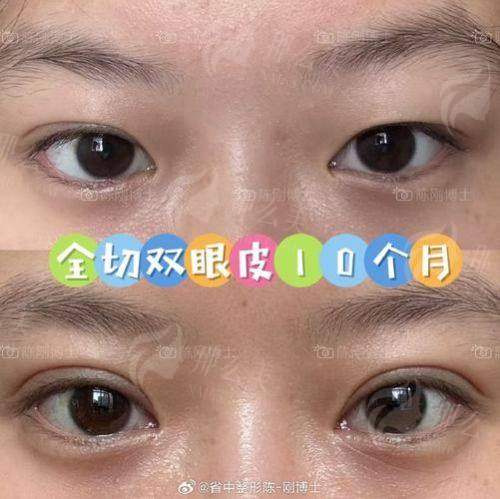 三、武汉美丽力量章海燕双眼皮价格贵吗?