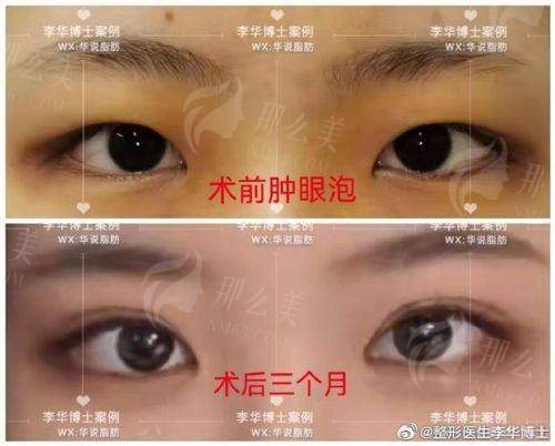 四、武汉美丽力量章海燕双眼皮怎么预约?