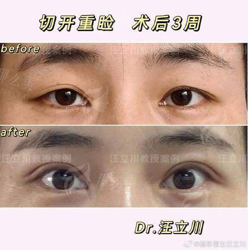 四、青岛华颜美双眼皮整形术后护理要点