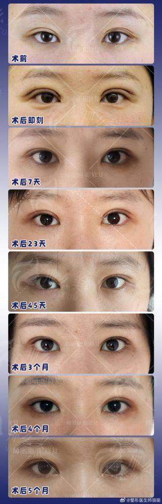 三、北京英煌整形王勋医生眼修复价格及预约方式