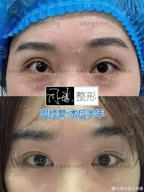 北京英煌整形王勋医生眼修复口碑如何？失败修复真实反馈，到院地址分享！