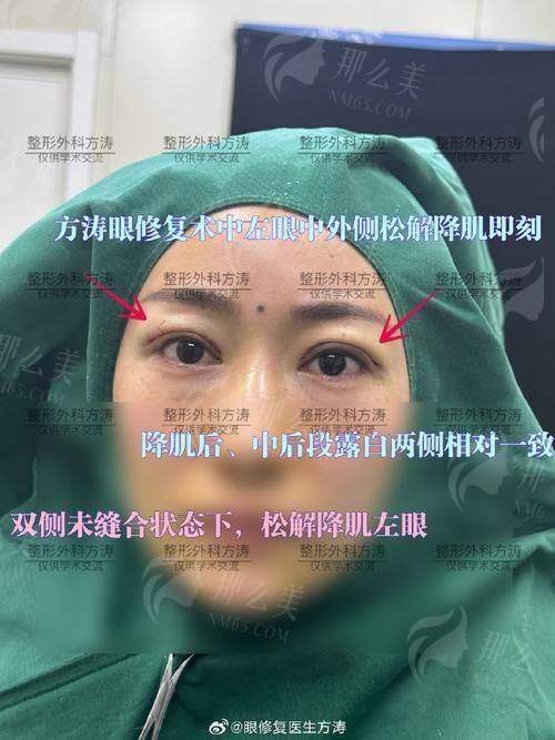 二、北京英煌整形王勋医生眼修复口碑如何?真实反馈分享