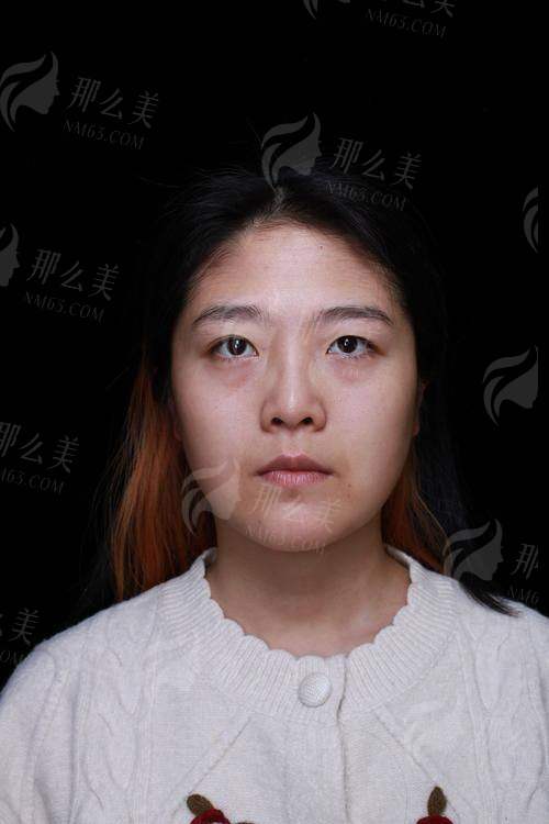 一、苏州美莱美容医院的祛眼袋项目怎么样?