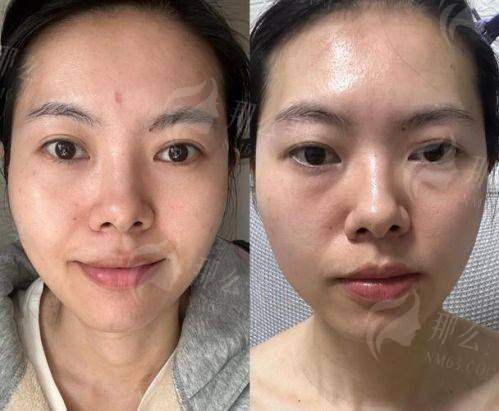 二、于加平、吴静医生的祛眼袋技术特色是什么?