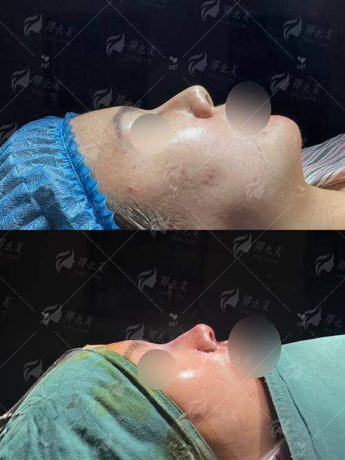 山东菏泽御美汇朱洪涛隆鼻修复怎么样？真实案例+价格全解析