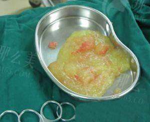 三、广州家庭医生整形医院异物取出有什么优势?内窥镜技术详解