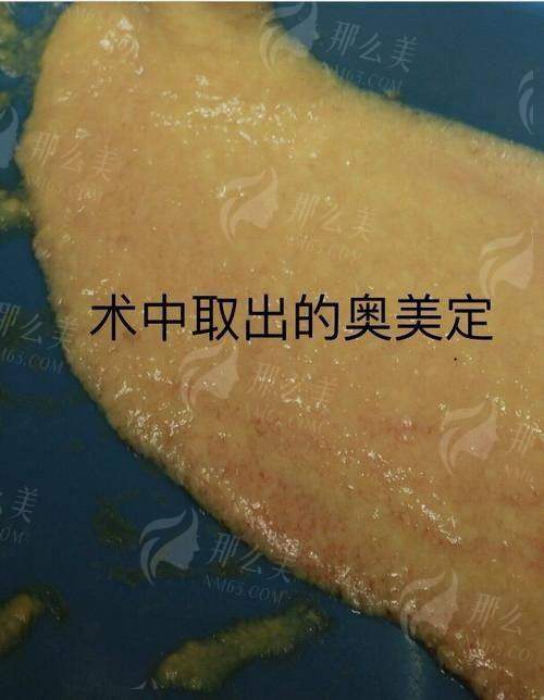 四、广州医美异物取出怎么选?三家医院对比+预约指南