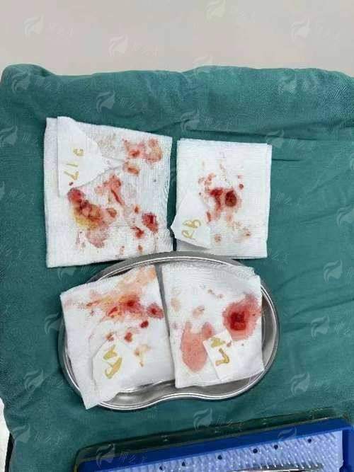 广州高尚医美异物取出怎么样？医生技术解析+预约方式，附真实案例！