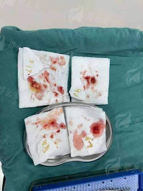 一、广州高尚医美异物取出怎么样?医生技术大起底