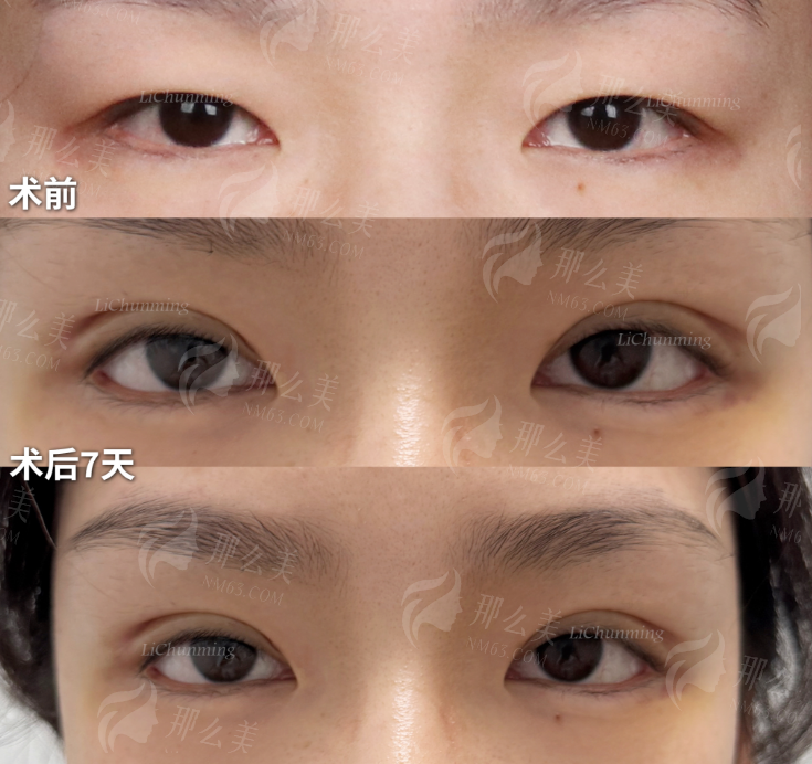 武汉艺星孙家明和杨国粱双眼皮谁最自然大揭秘，含医生特色技术及预约方式