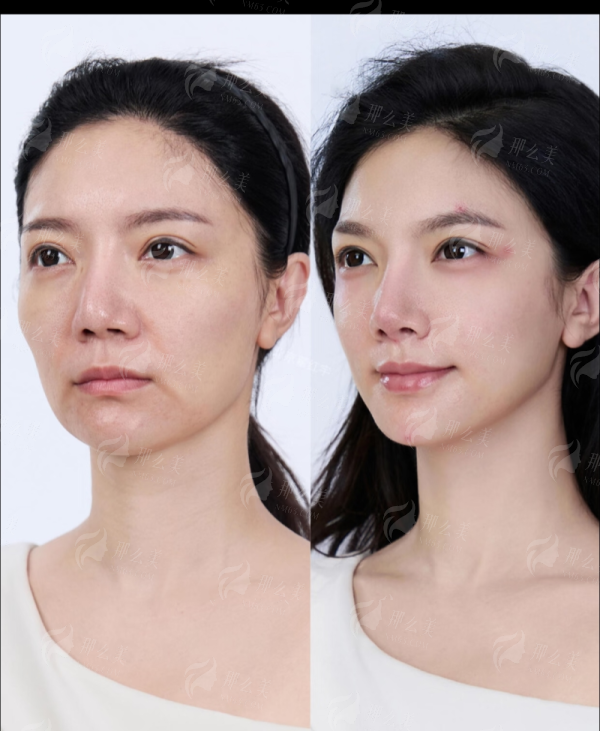 眶隔前置祛眼袋 4980 元起！惠州稚美医疗，蒙石南医生亲诊 + 长期质保