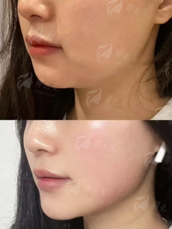 三、杨国粱医生手术风格剖析