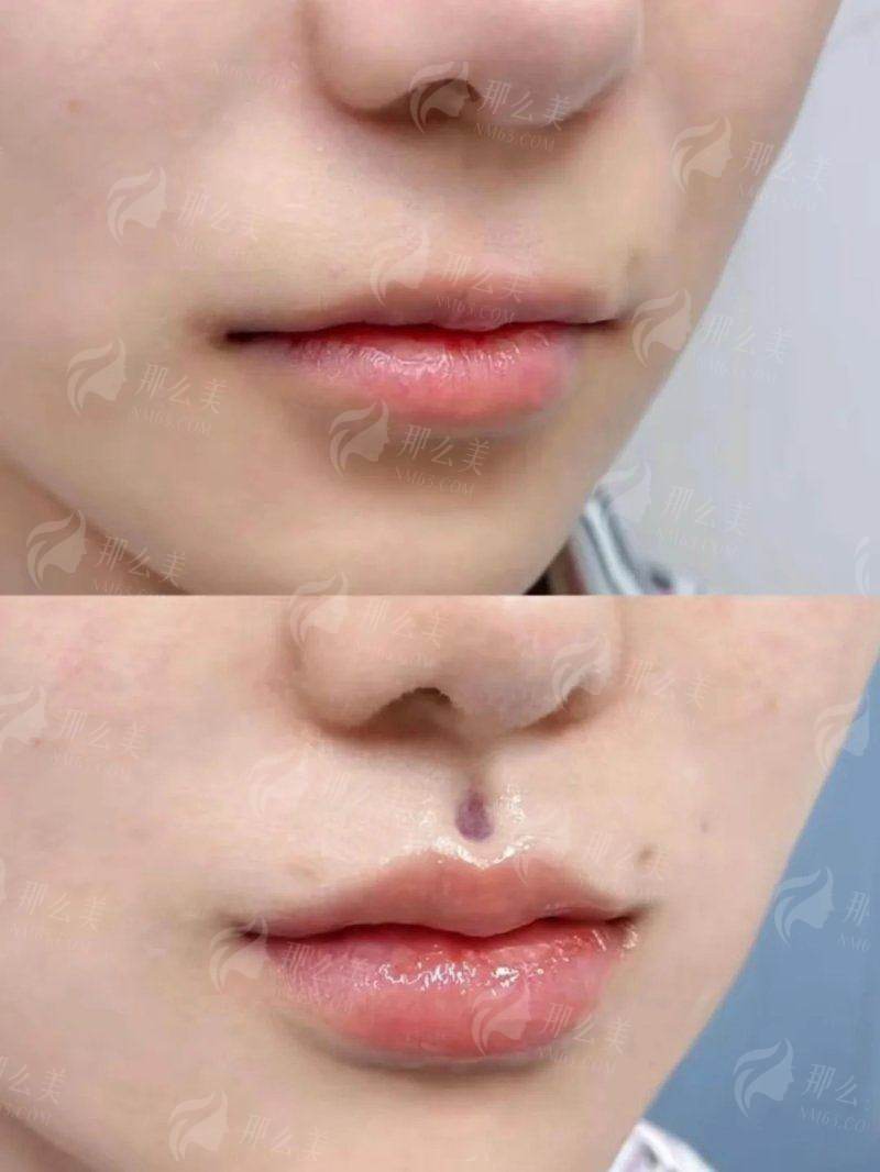 一、重庆美莱玻尿酸注射2025价格表全公开!进口国产怎么选?