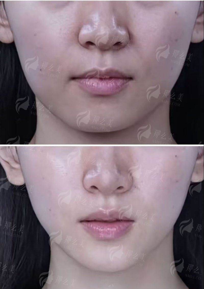 三、重庆美莱玻尿酸注射避坑指南!这些套路要当心
