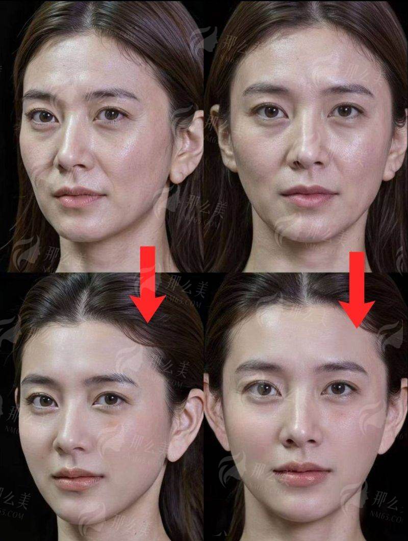 四、重庆美莱玻尿酸注射省钱攻略!这样买立省2000+