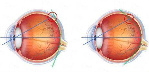 梅州爱明眼科医院：如何预约就诊