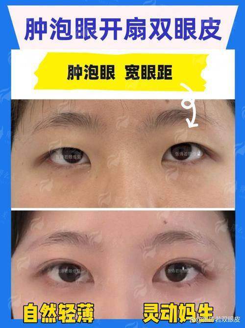 二、上海韩卓医疗全切双眼皮手术过程痛不痛？