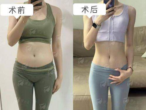 二、广州雅贝壹腰腹吸脂成效到底如何?