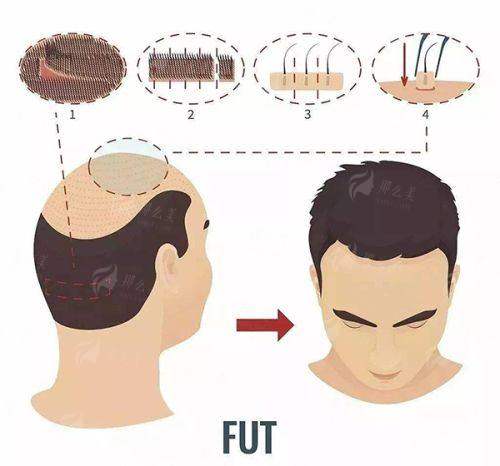 郑方成院长毛发种植技术靠谱吗？温州青禾植发价格+效果对比，避坑指南！