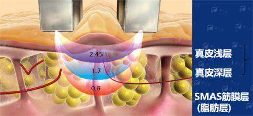 二、苏州铂蔓富贵包整形价格贵不贵？