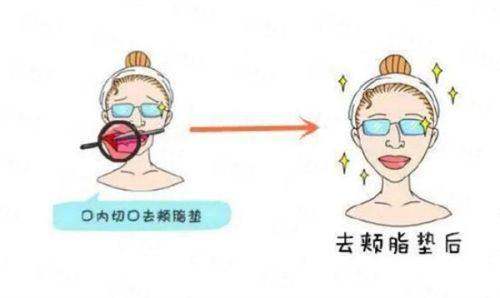 四、怎么预约苏州铂蔓的富贵包整形？