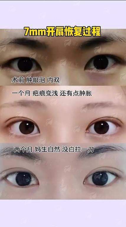 张兆博双眼皮技术靠谱吗？临汾美特尔整形医生特色+术后效果对比！