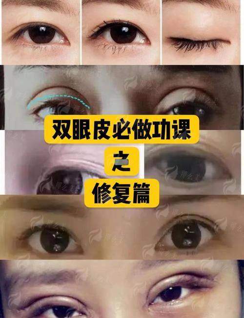 三、张兆博双眼皮价格贵吗？临汾同城项目对比