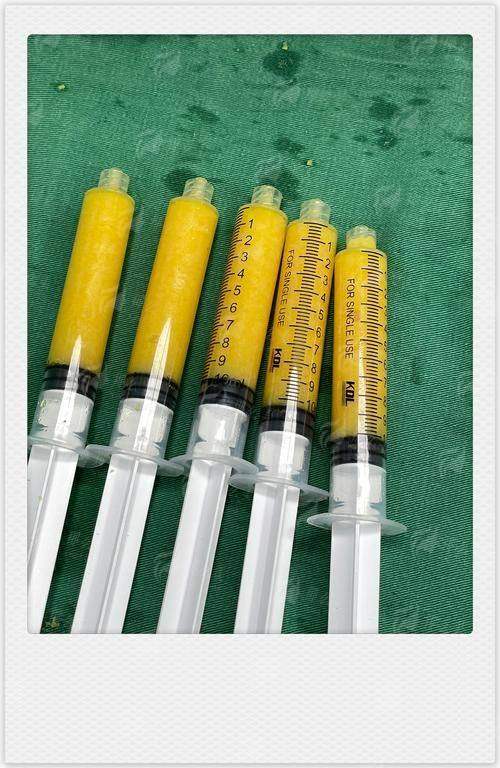 天津伊颂腰腹环吸吸脂靠谱吗？术后恢复全解析，吸脂不反弹的秘密在这！