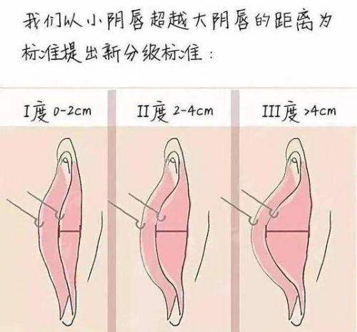 二、合肥民众医院私密科的小阴唇整形价格贵不贵？