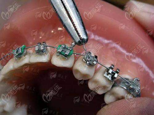 牙齿隐形矫正哪家强？深圳汇港口腔真实案例分享，附到院地址+预约方式！