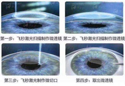 四、合肥普瑞眼科飞秒激光怎么预约？术后要注意什么？