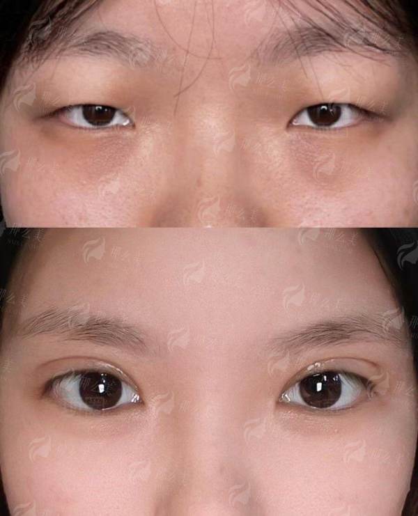 上海韩卓做双眼皮靠谱吗？真实案例对比+术后效果全分享！