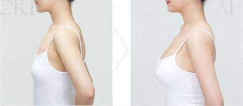 二、苏州薇琳美容医院做内窥镜隆胸成效如何？