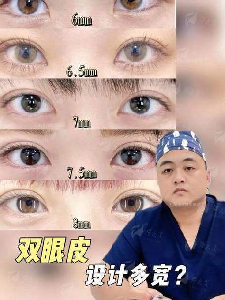 二、长沙华韩华美邓颖医生双眼皮风格对比