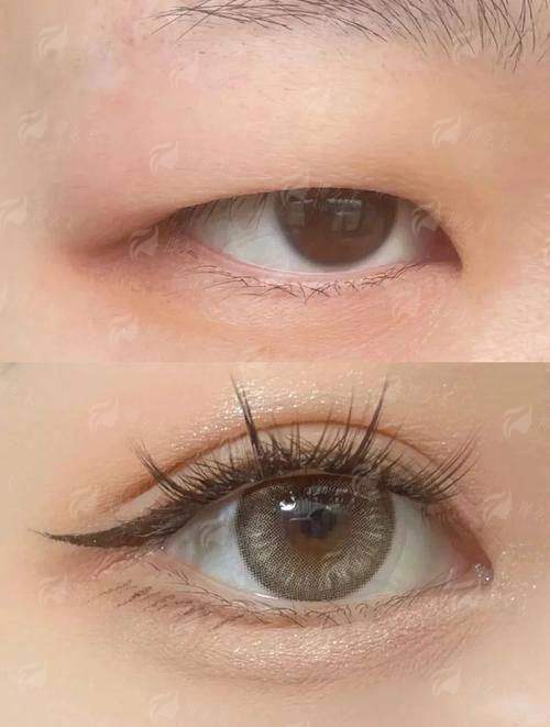 四、广州可玉双眼皮真实实例反馈