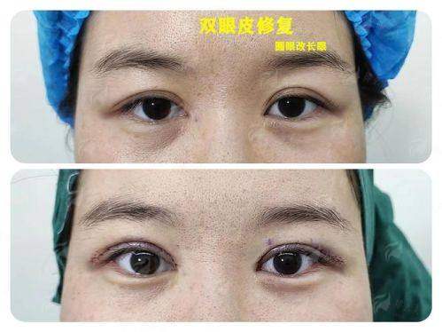 一、谢葵医生在云南昭通大菲医美做双眼皮修复靠谱吗？