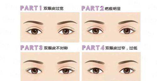 一、广州可玉医疗美容的双眼皮技术强在哪?