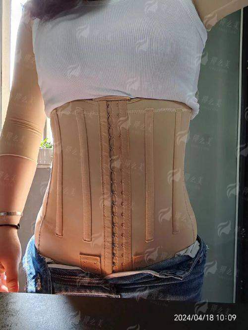 真实实例分享：我的大腿吸脂成效对比