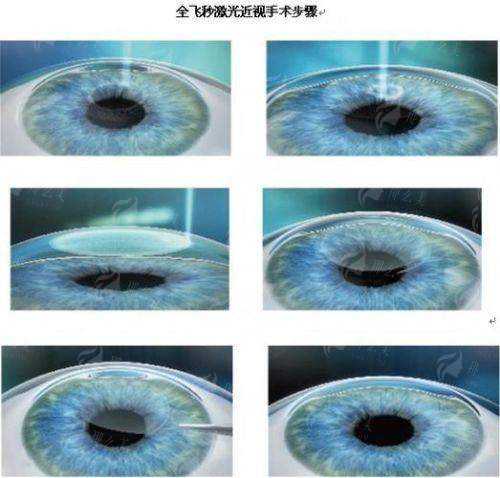 二、武汉阿玛施眼科门诊的全飞秒手术价格如何?