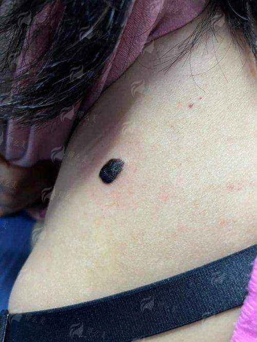 一、北京广济医院疤痕科刘霞医生靠谱吗?20年经验不是盖的!