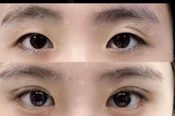 三、肖培卫医生在长沙华韩华美的眼部整形表现