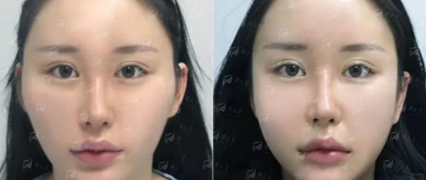 二、广大整形罗延平医生双眼皮真实实例对比