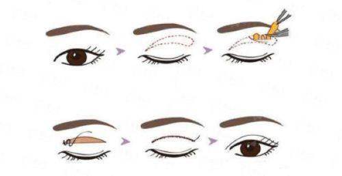 二、天津爱丽诺整形张剑锋医生的双眼皮技术强在哪?