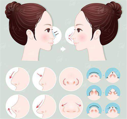 六、选择广东韩妃整形外科医院李光琴医生的四大理由