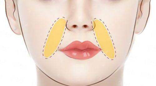 二、广东韩妃整形外科医院祛眼袋手术方式介绍