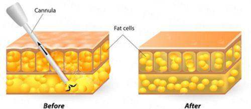 四、广东韩妃整形外科医院梁晓姻医生手术特点